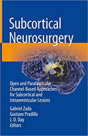 Subcortical Neurosurgery Open and Parafascicular Channel Based Approaches for Subcortical and Intraventricular Lesions